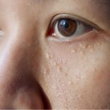 Huidpraktijk Rhoon: weg met gerstekorrels!