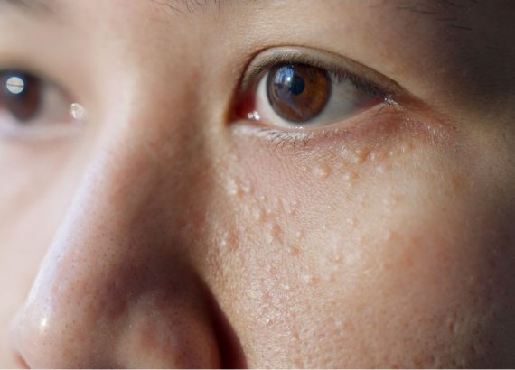 Huidpraktijk Rhoon: weg met gerstekorrels!