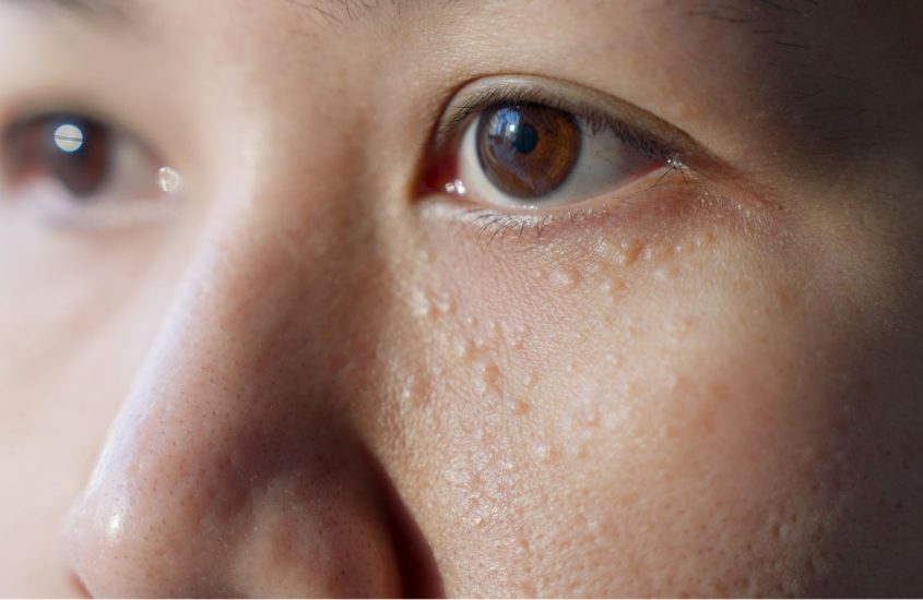 Weg met gerstekorrels!